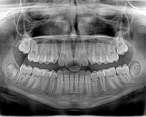 xray-x-ray-x-ray-photo-roentgen
