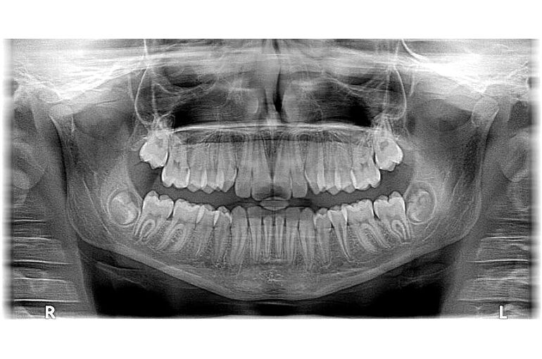 xray-x-ray-x-ray-photo-roentgen
