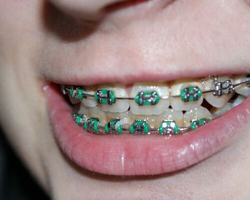tooth-dental-braces-bite-mouth