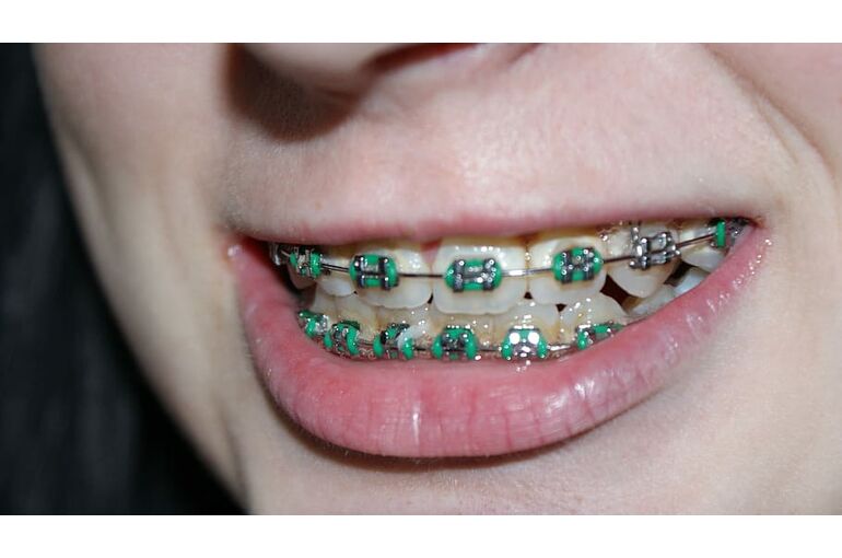 tooth-dental-braces-bite-mouth