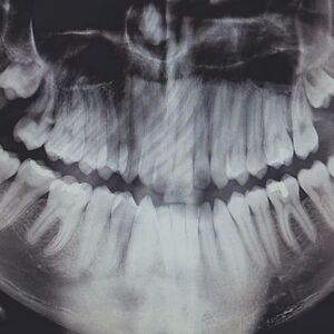 united-states-poulsbo-x-ray-teeth