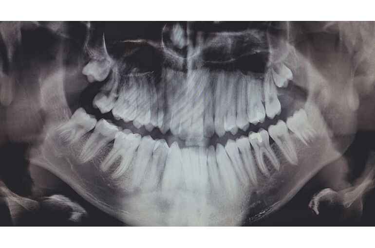 united-states-poulsbo-x-ray-teeth